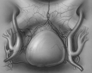 PCOS